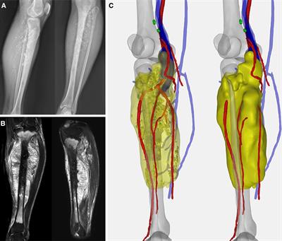 Case Report: 3D-Printed Prosthesis for Limb Salvage and Joint Preservation After Tibial Sarcoma Resection